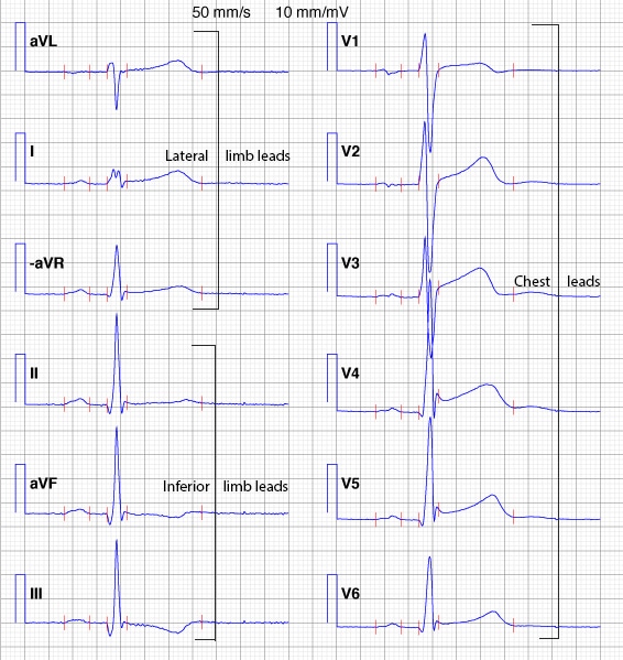 نمونه ای از ECG با سیستم کابررا