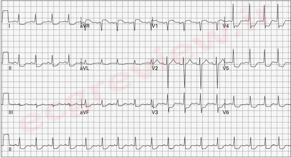 LMCA obstruction left main coronary artey three vessel disease - 3VD