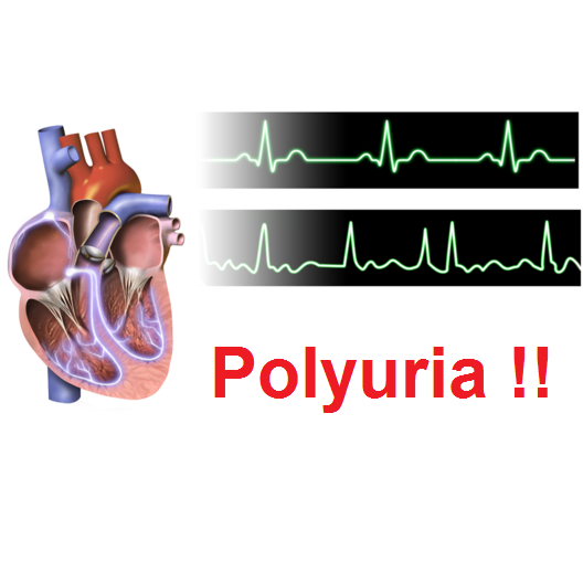 Polyuria-tachycardia, posttachycardia diuresis, tachycardia-associated polyuria, تاکی کاردی ناشی از پلی اوری