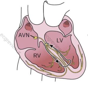 Bundle Branch Reentry VT