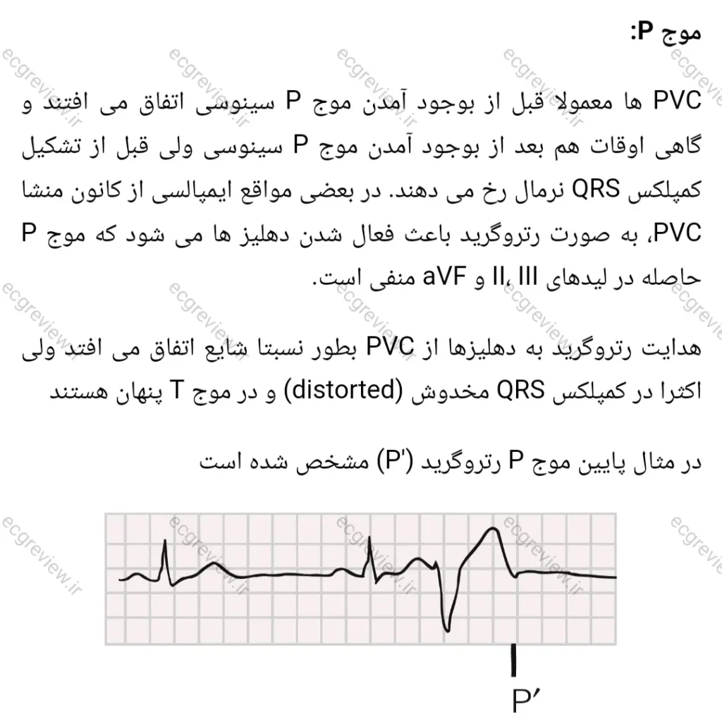 retrograde P wave 